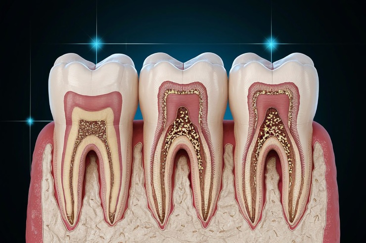 Root-canals